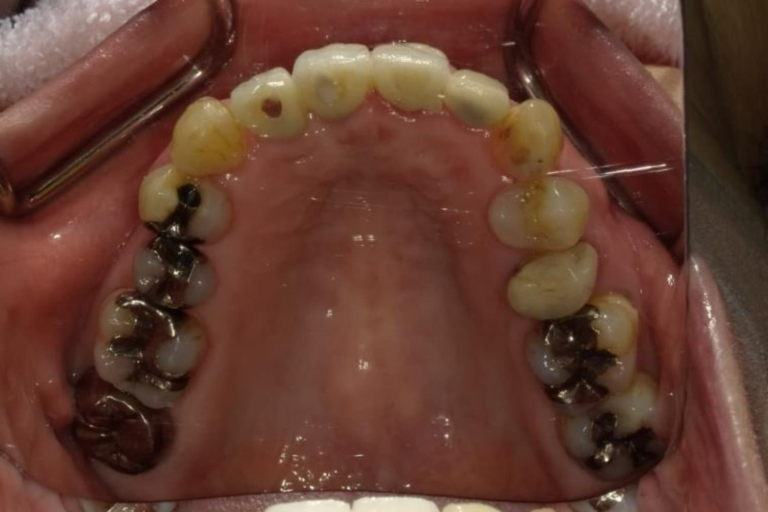 インプラント治療後2
