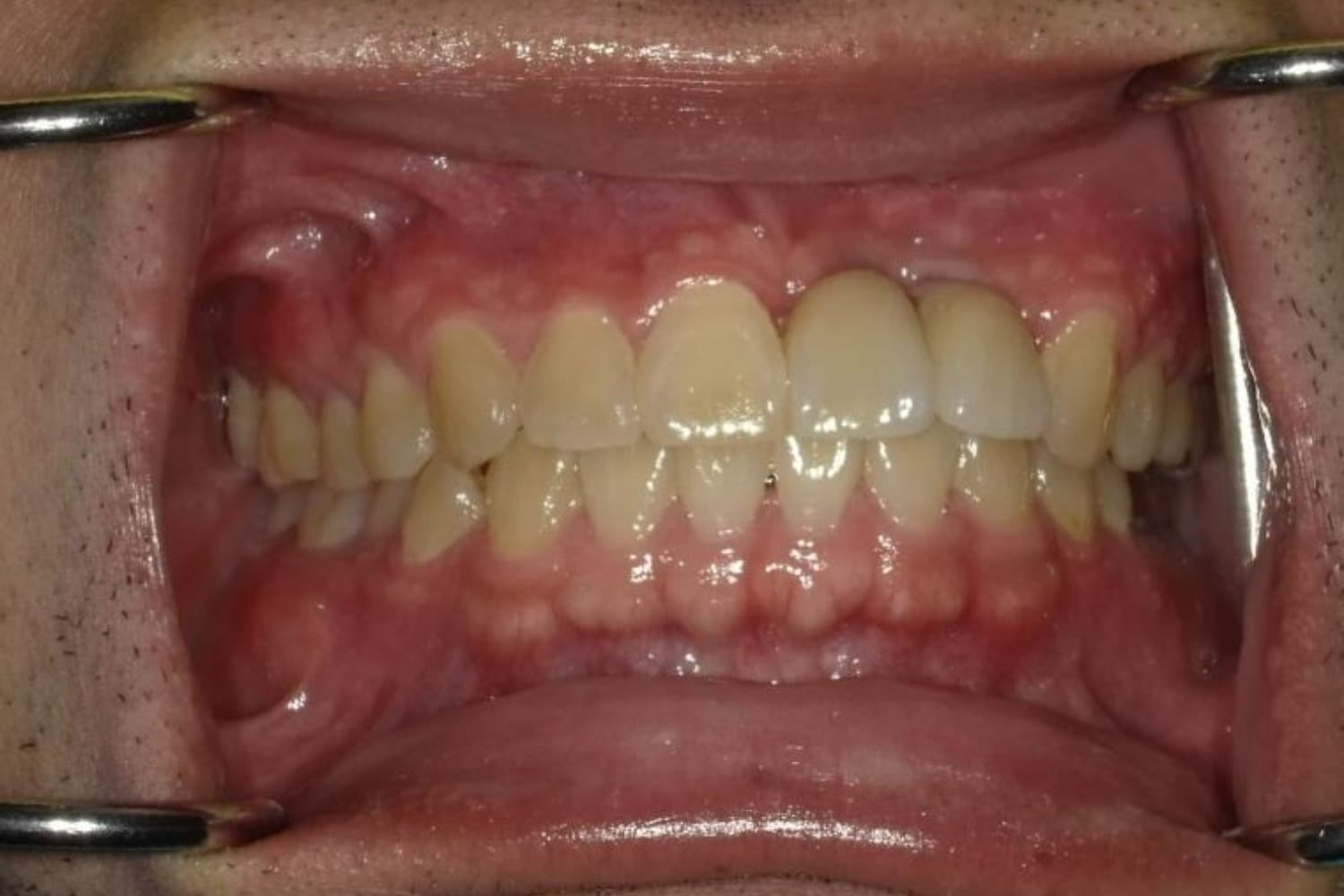 インプラント治療後1