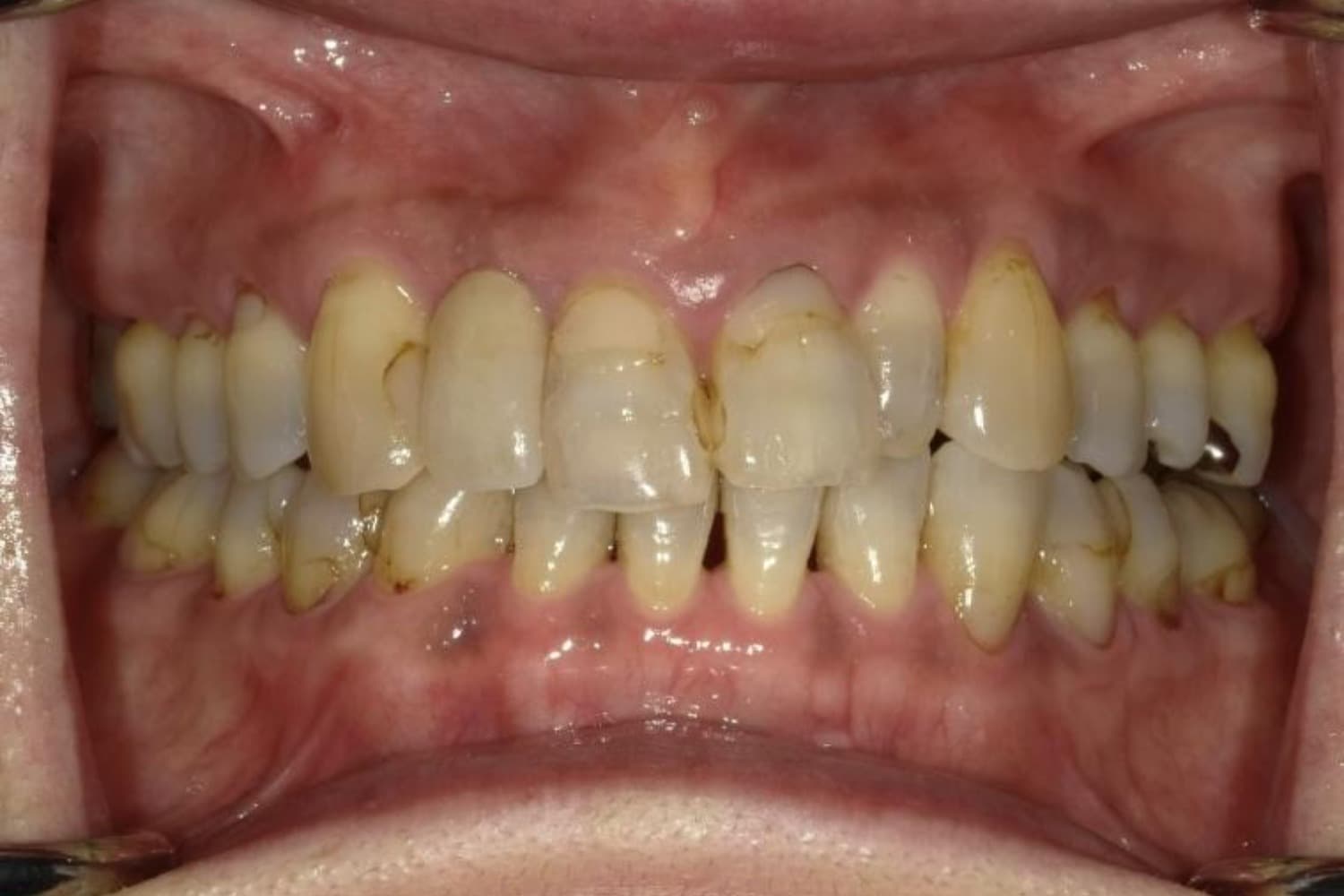 インプラント治療後1