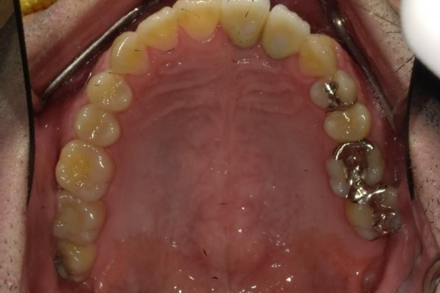 インプラント治療後2