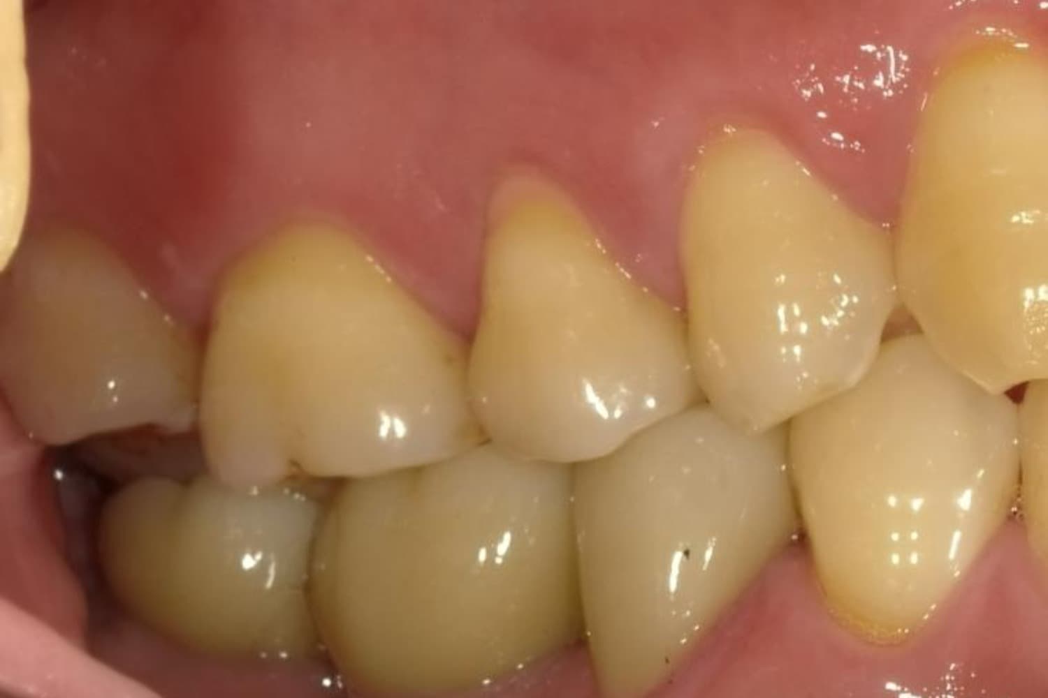 インプラント治療後