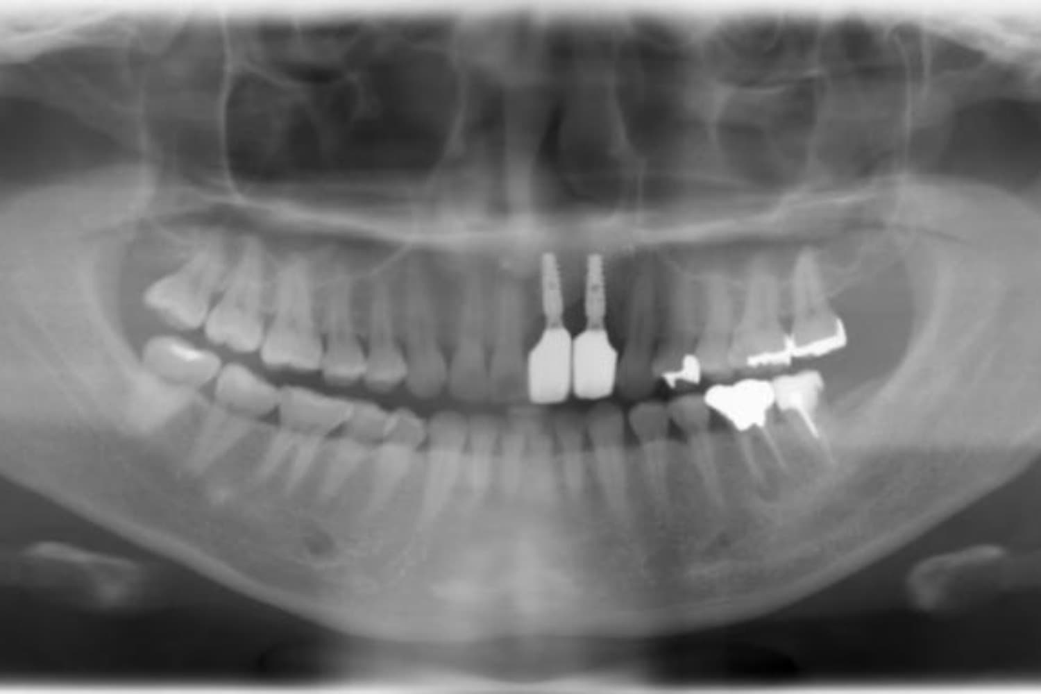 インプラント治療後3(レントゲン)