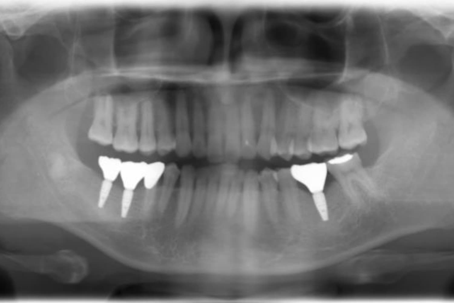 インプラント治療後(レントゲン)