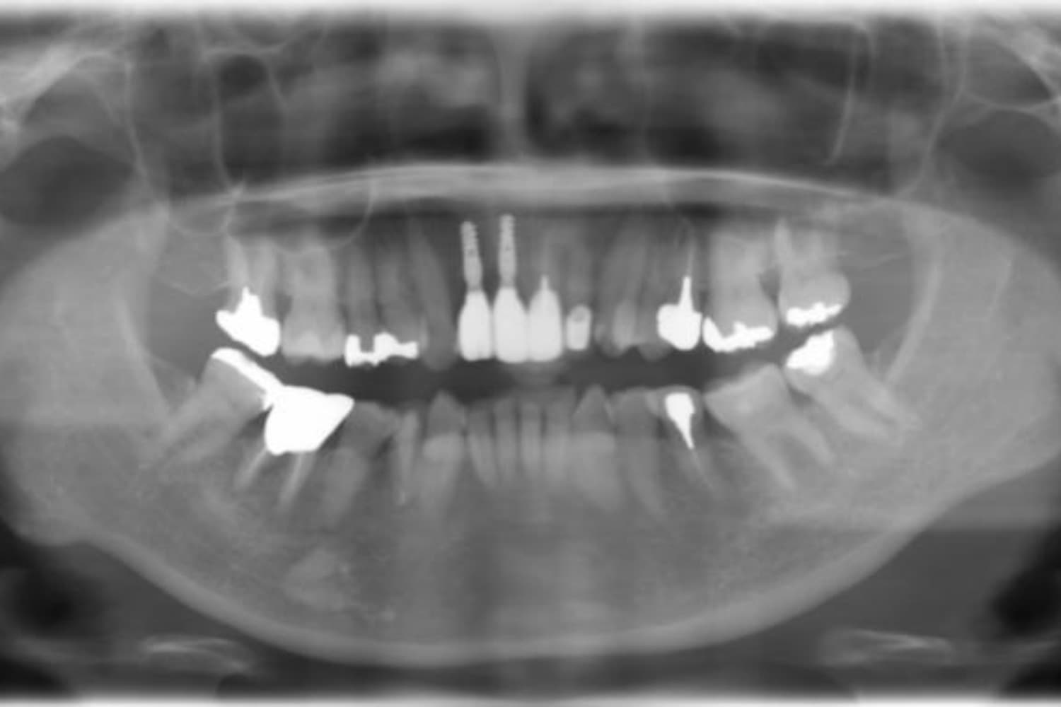 インプラント治療後3(レントゲン)