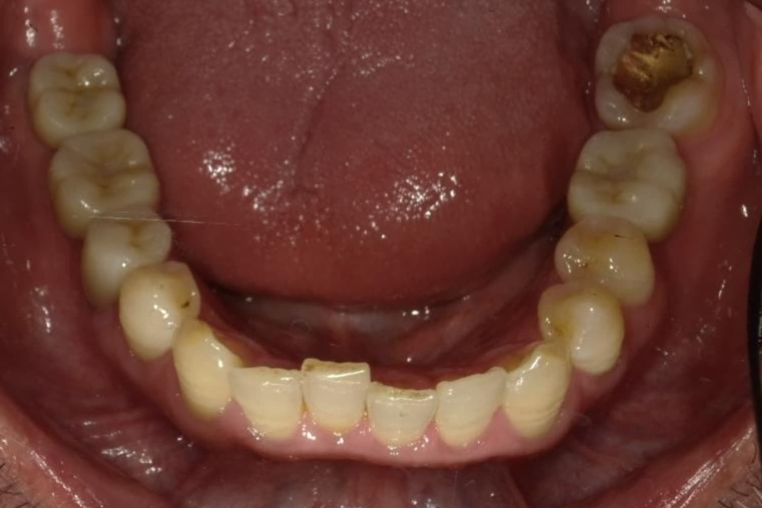 インプラント治療後