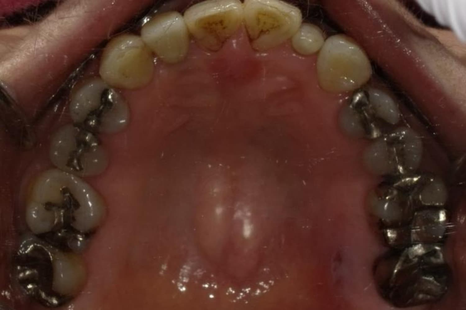 インプラント治療後2