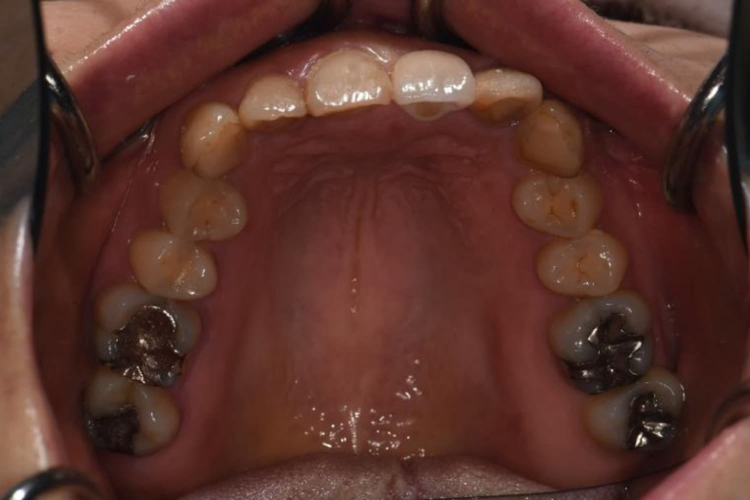 インプラント治療後2