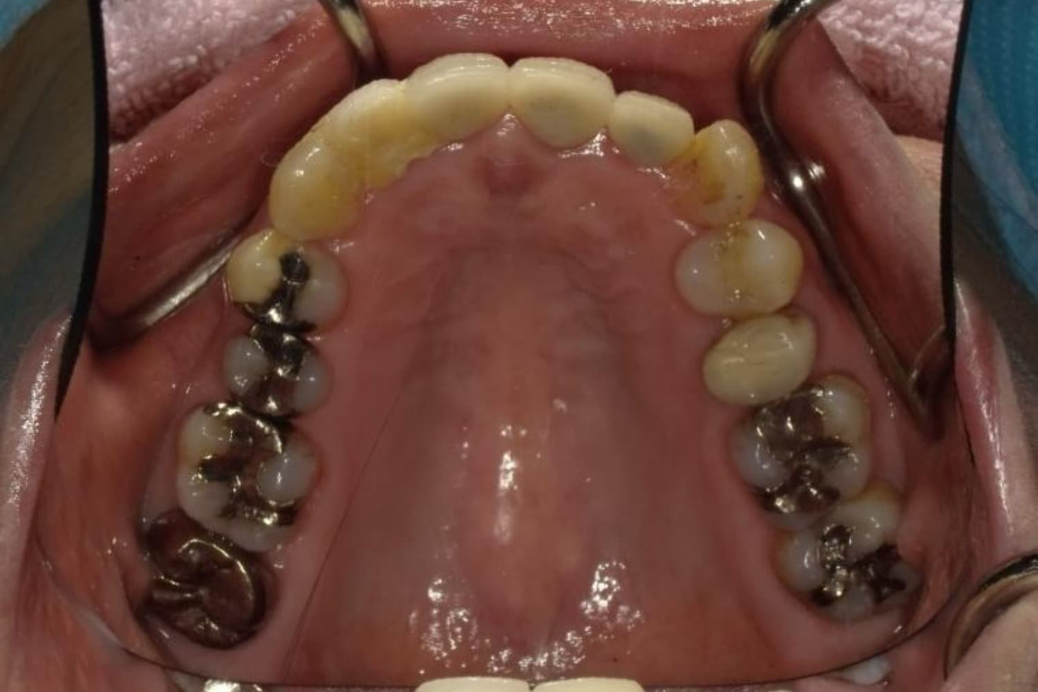インプラント治療前2