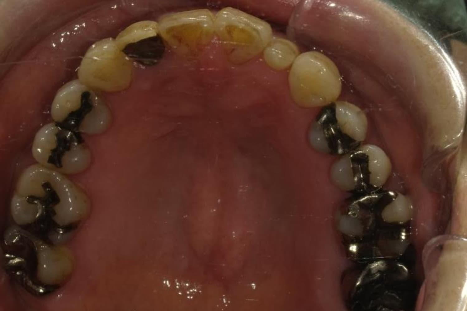 インプラント治療前2