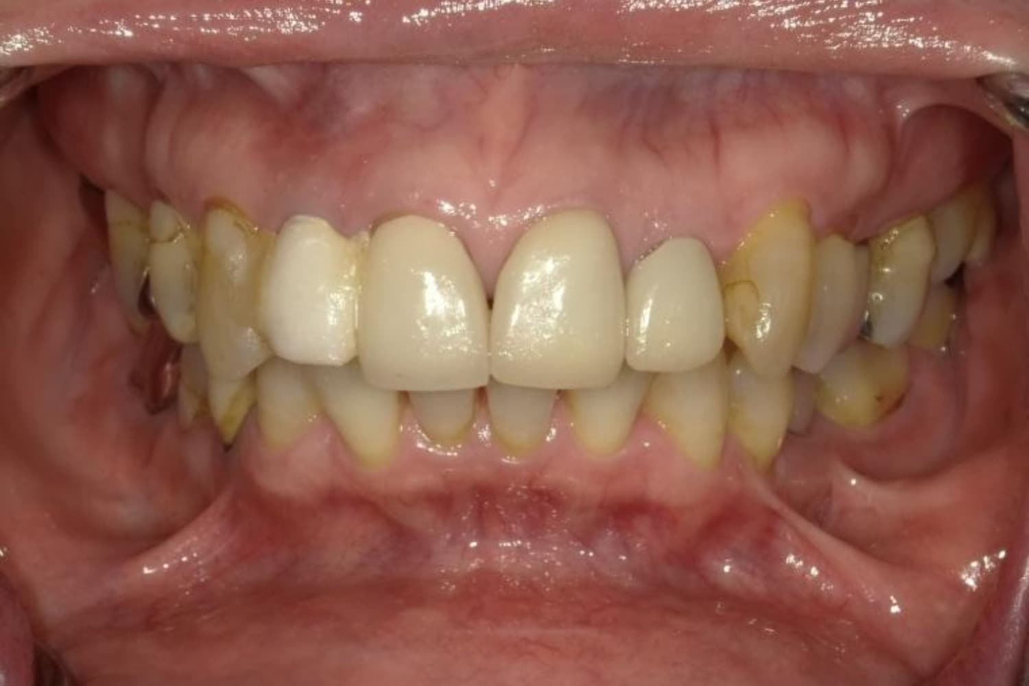 インプラント治療前1