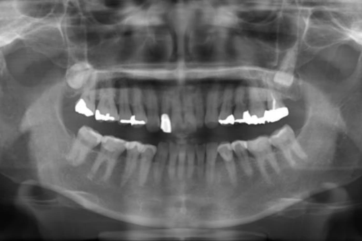 インプラント治療前3(レントゲン)