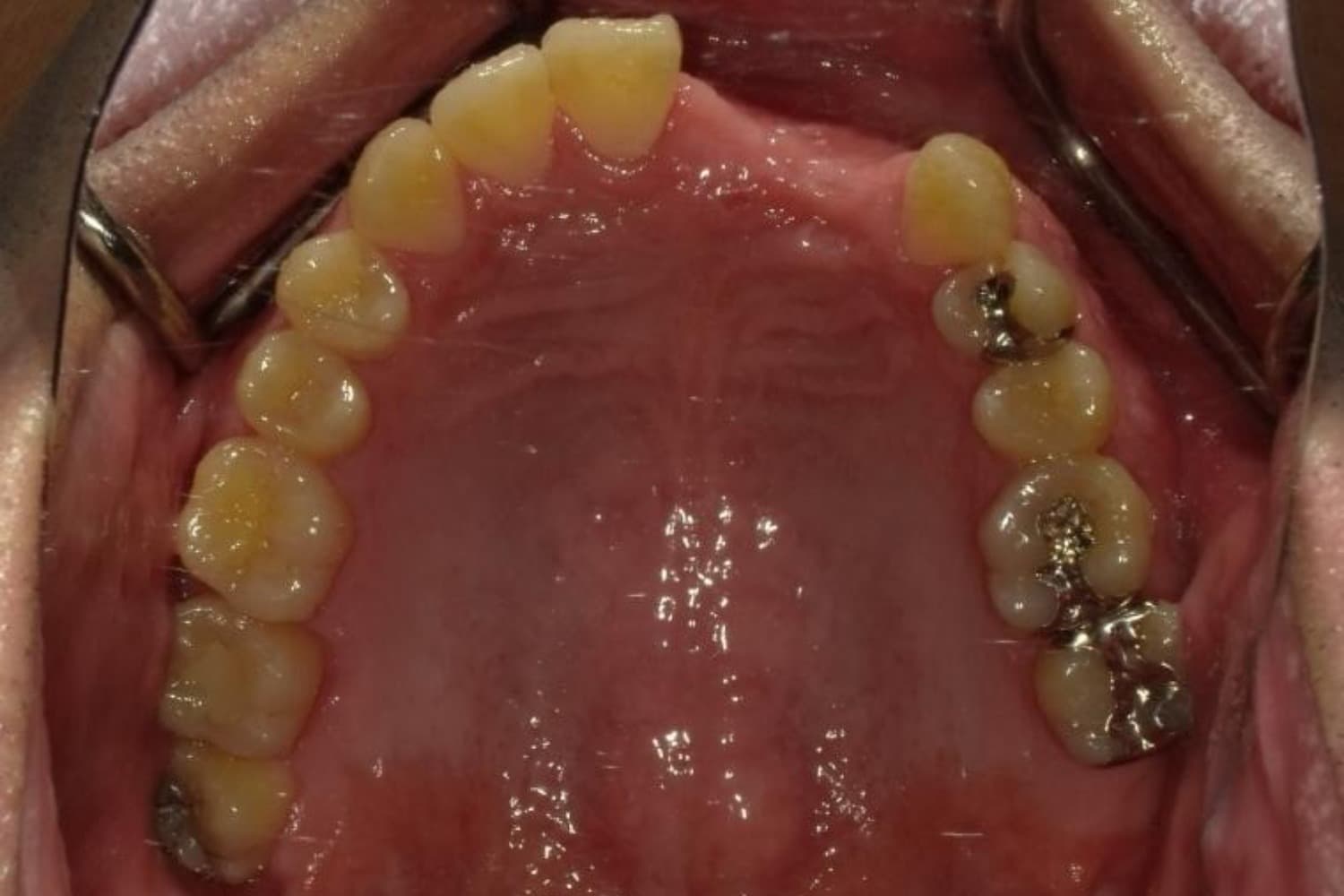 インプラント治療前2