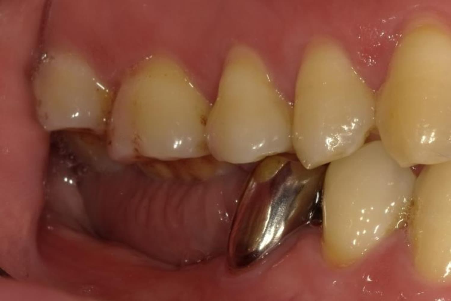 インプラント治療前