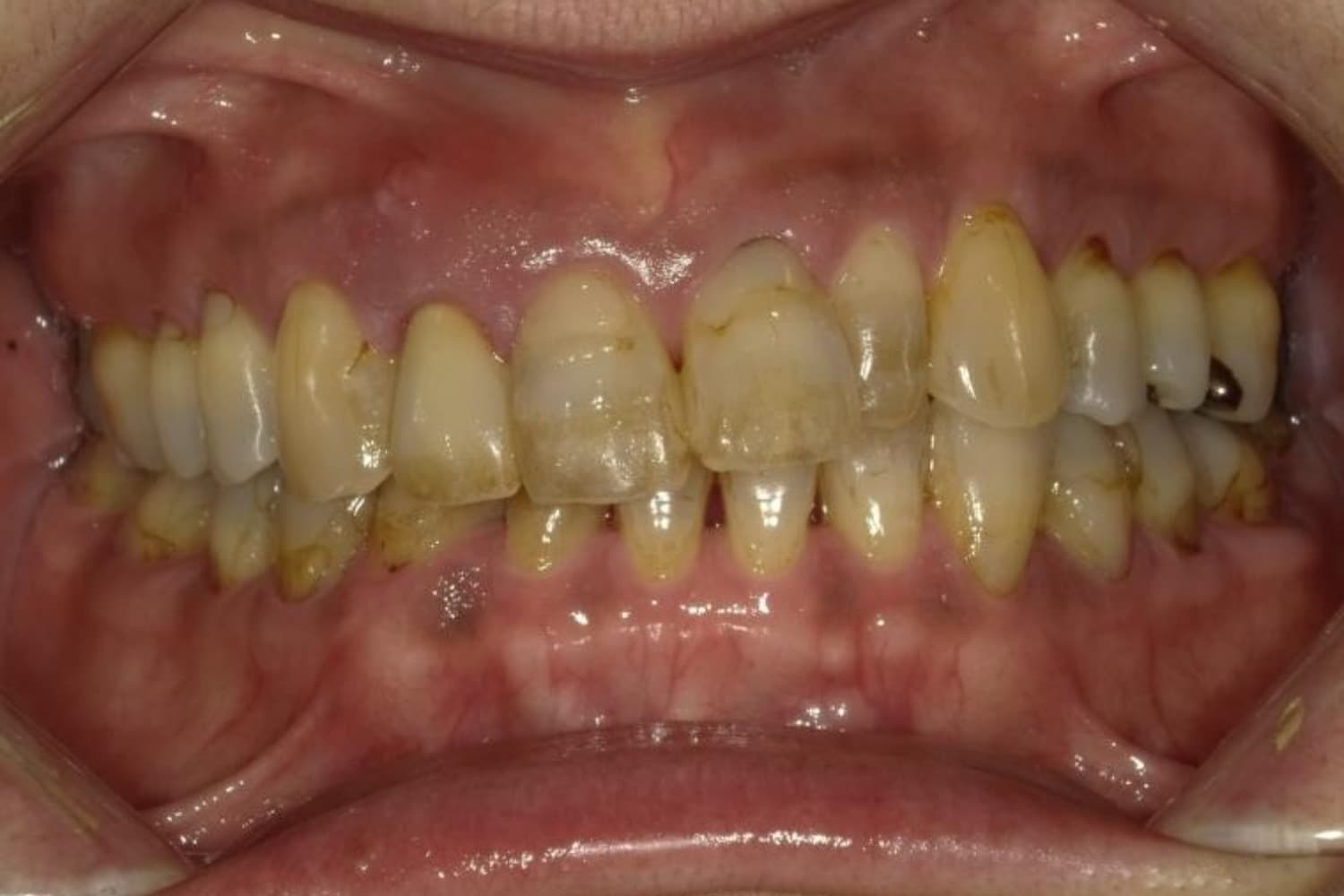 インプラント治療前1