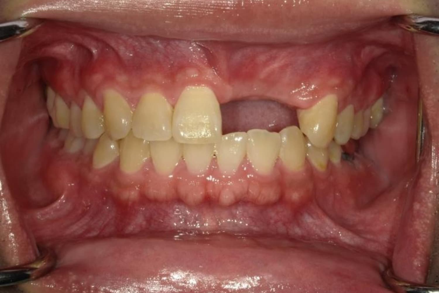 インプラント治療前1