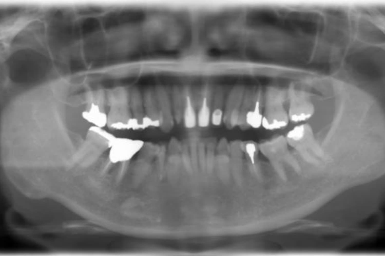 インプラント治療前3(レントゲン)
