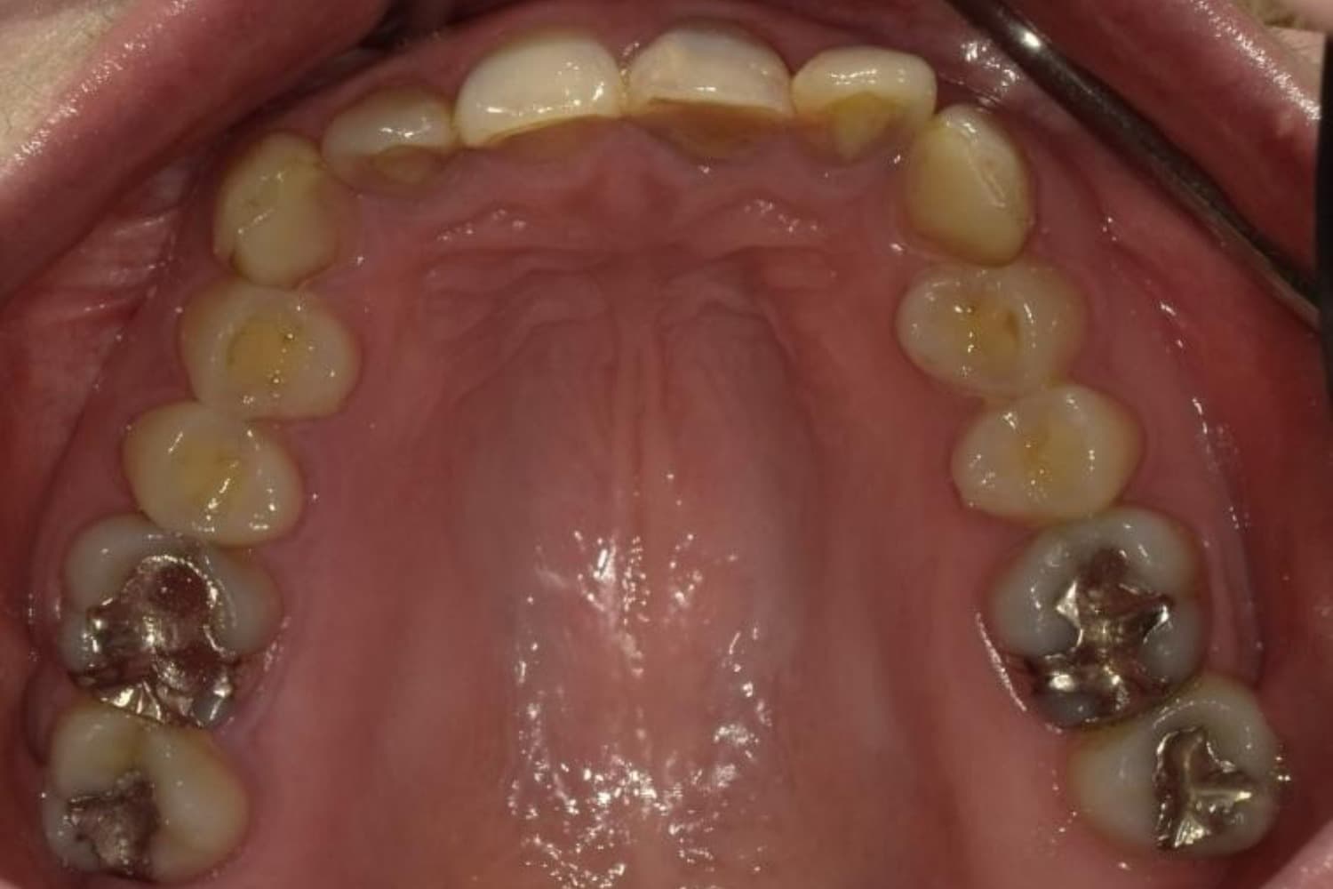 インプラント治療前2