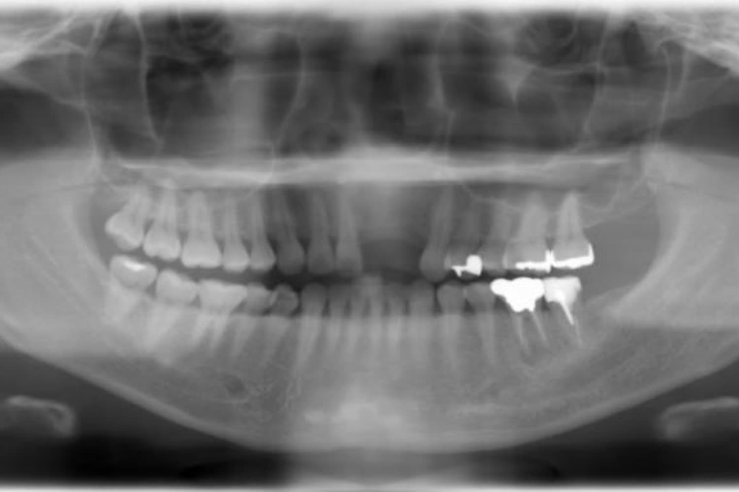 インプラント治療前3(レントゲン)