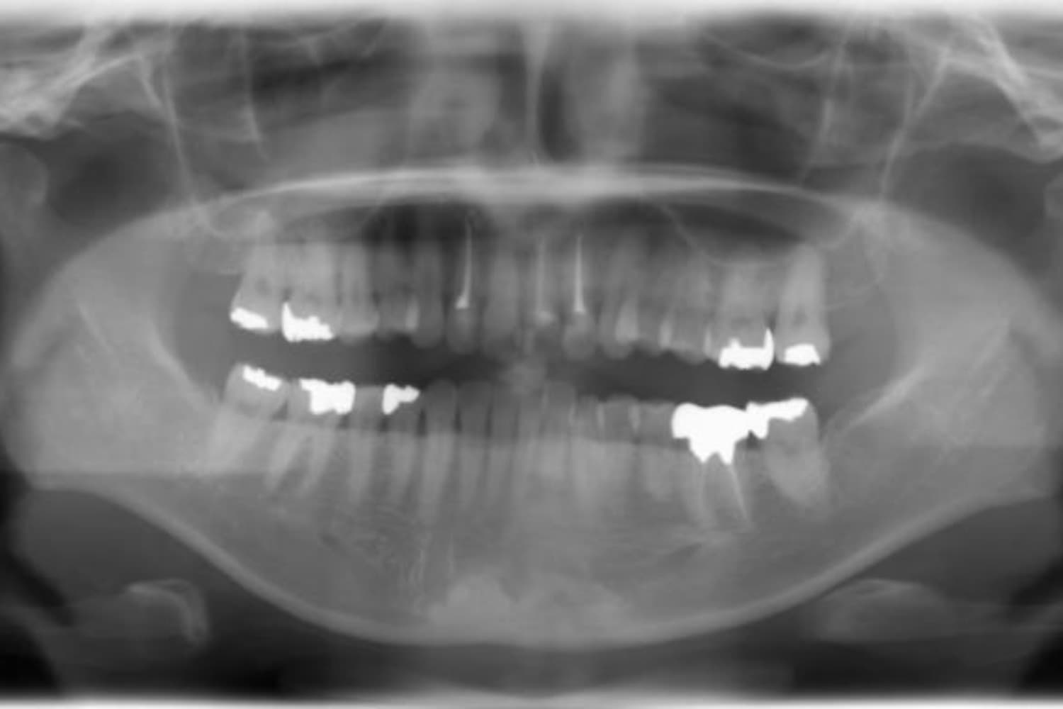 インプラント治療前3(レントゲン)