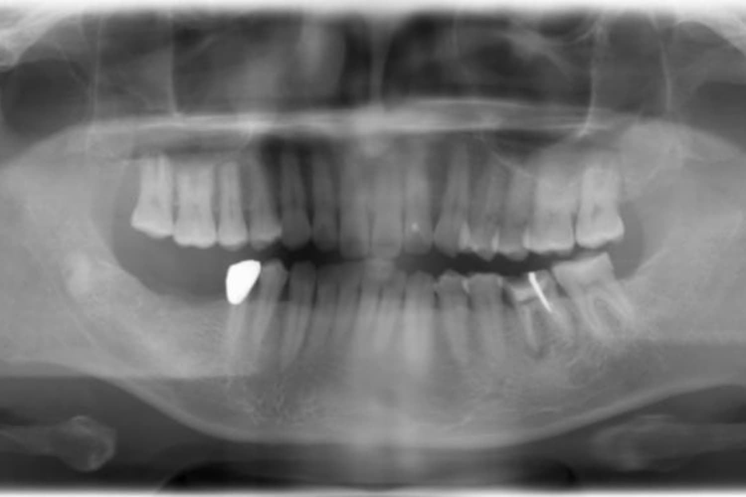 インプラント治療前(レントゲン)