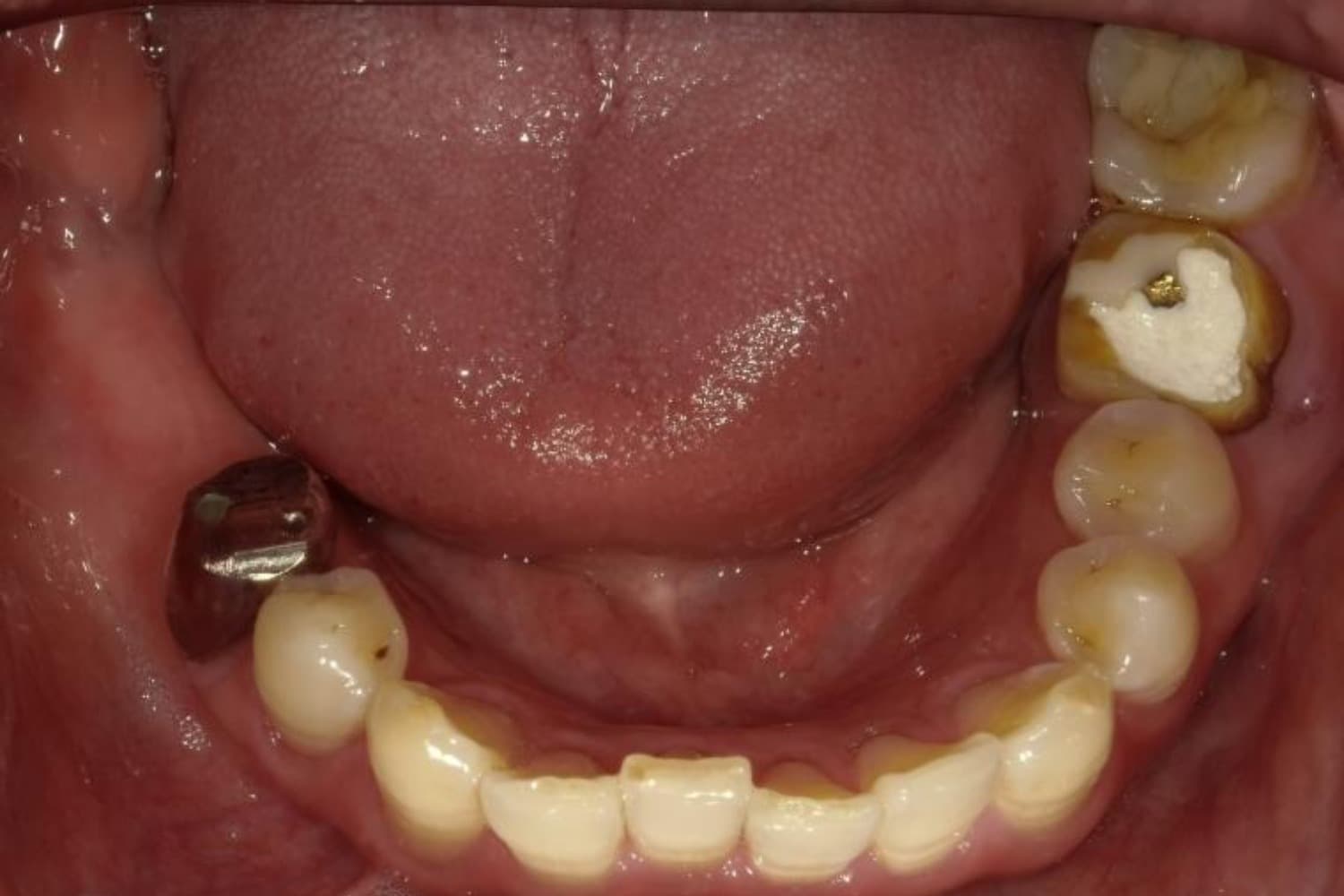 インプラント治療前