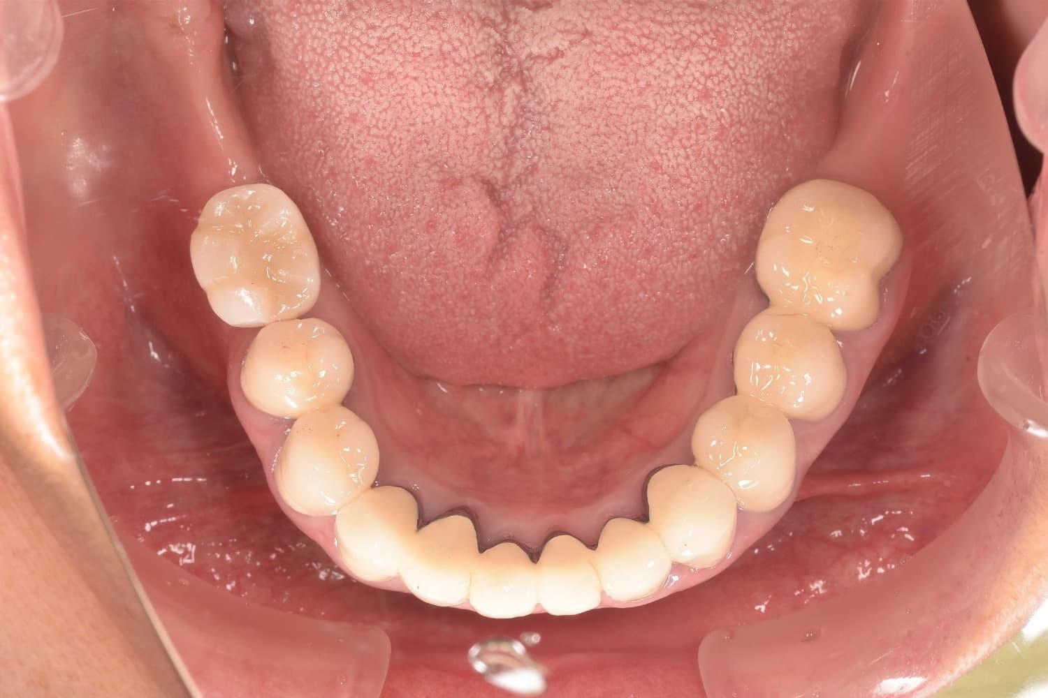 症例①インプラント治療後