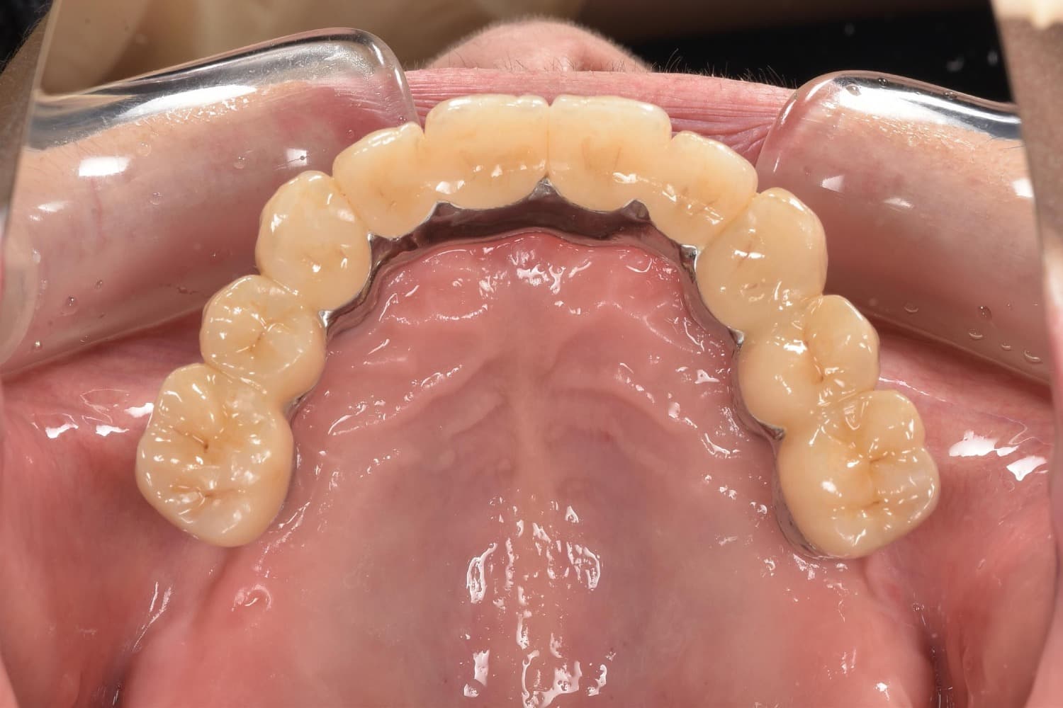 症例③インプラント治療後2