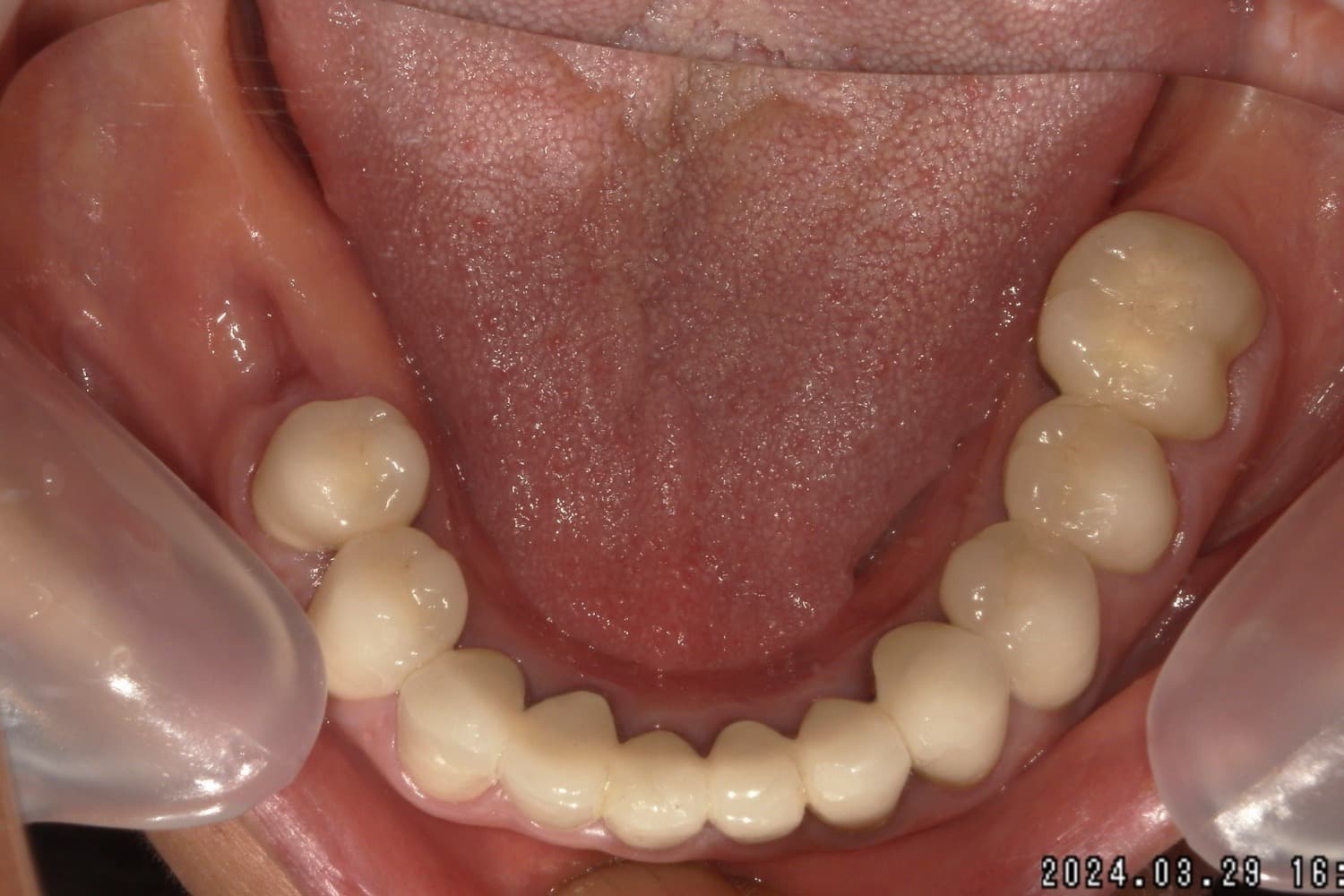 症例①インプラント治療前