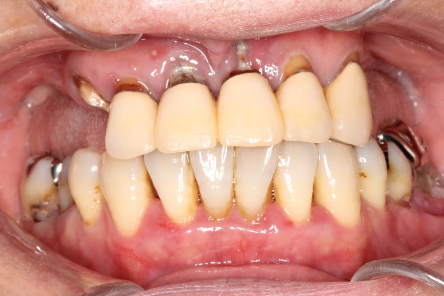 症例③インプラント治療前