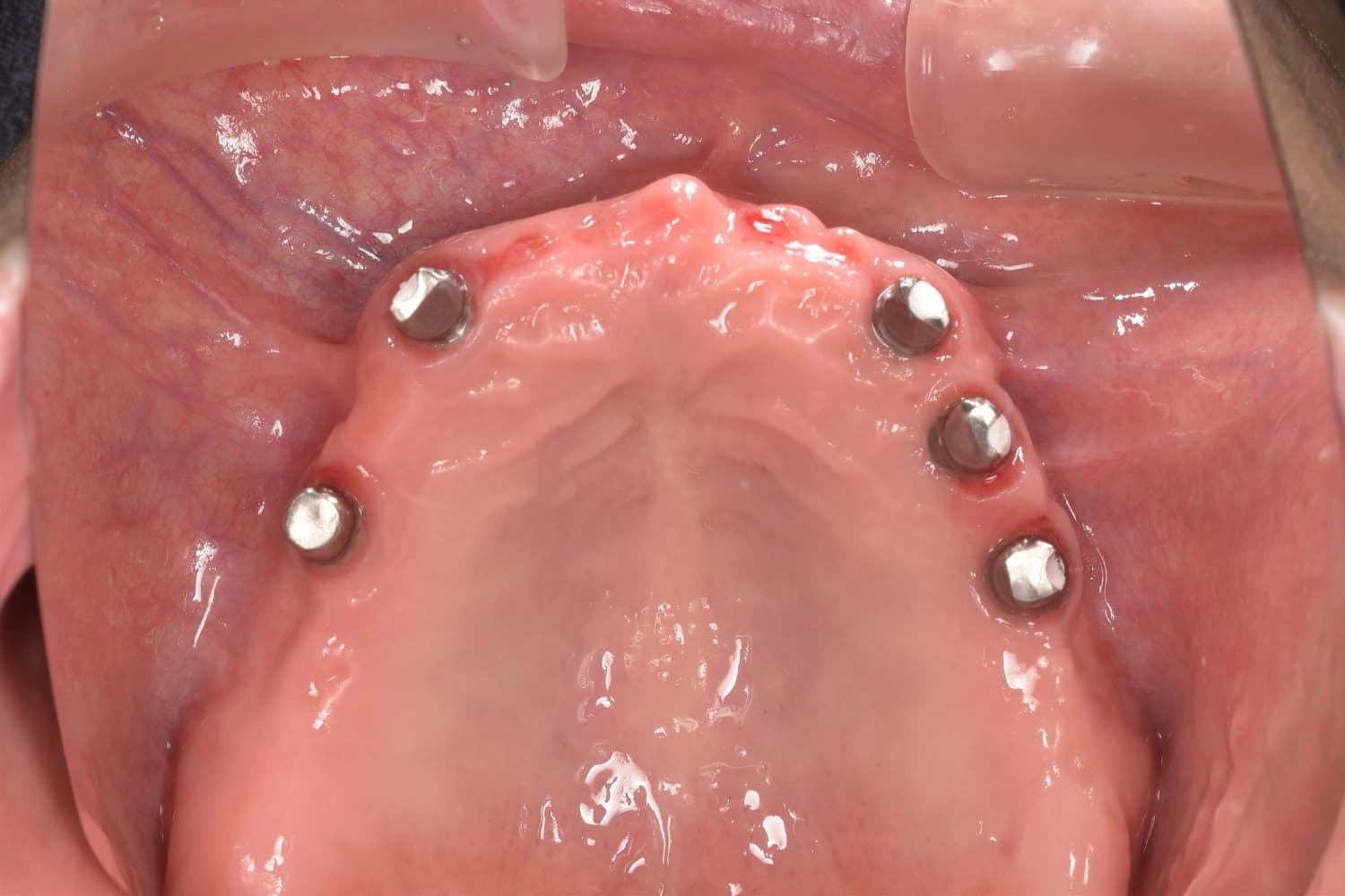 症例③インプラント治療前2