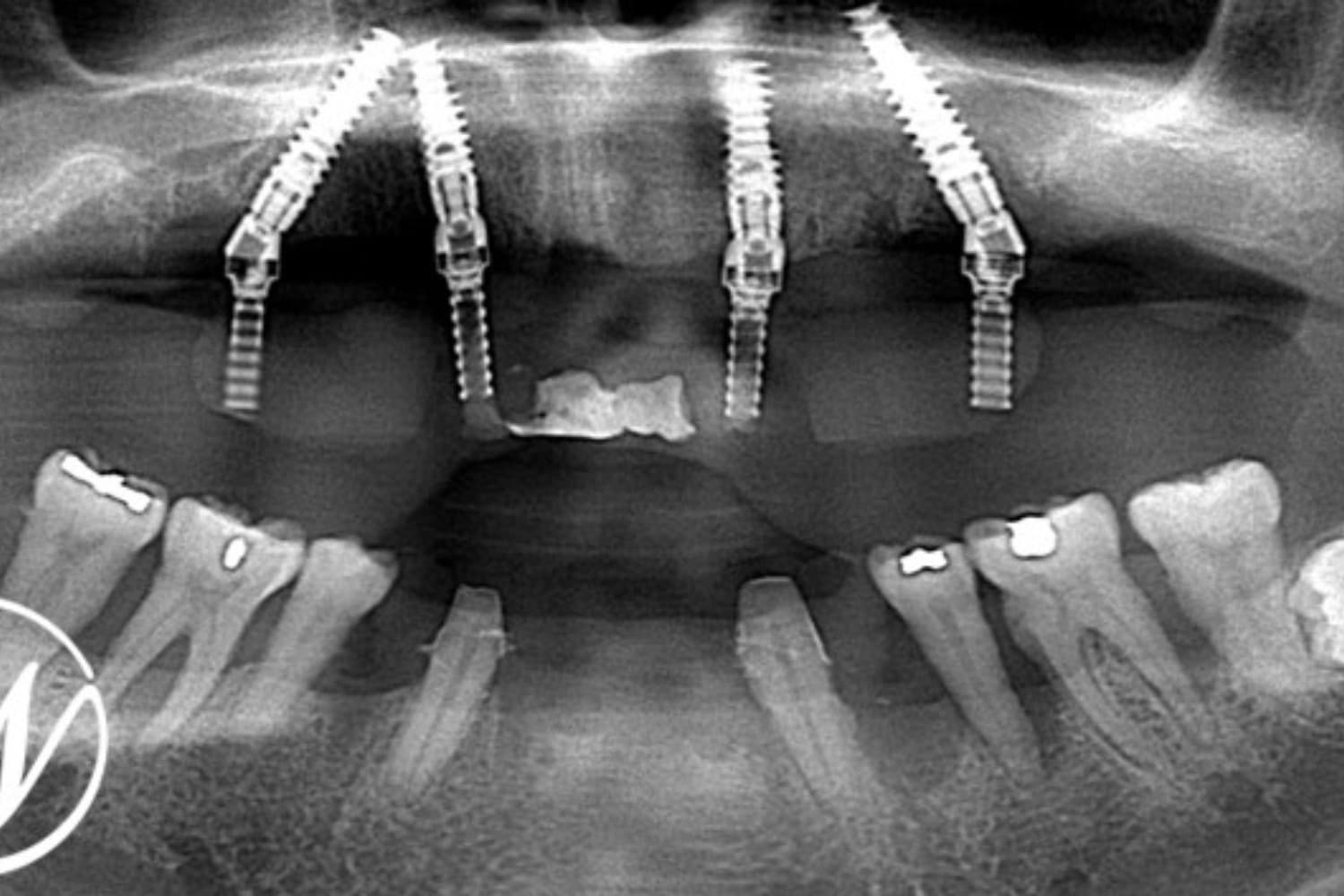 インプラント治療後(レントゲン)
