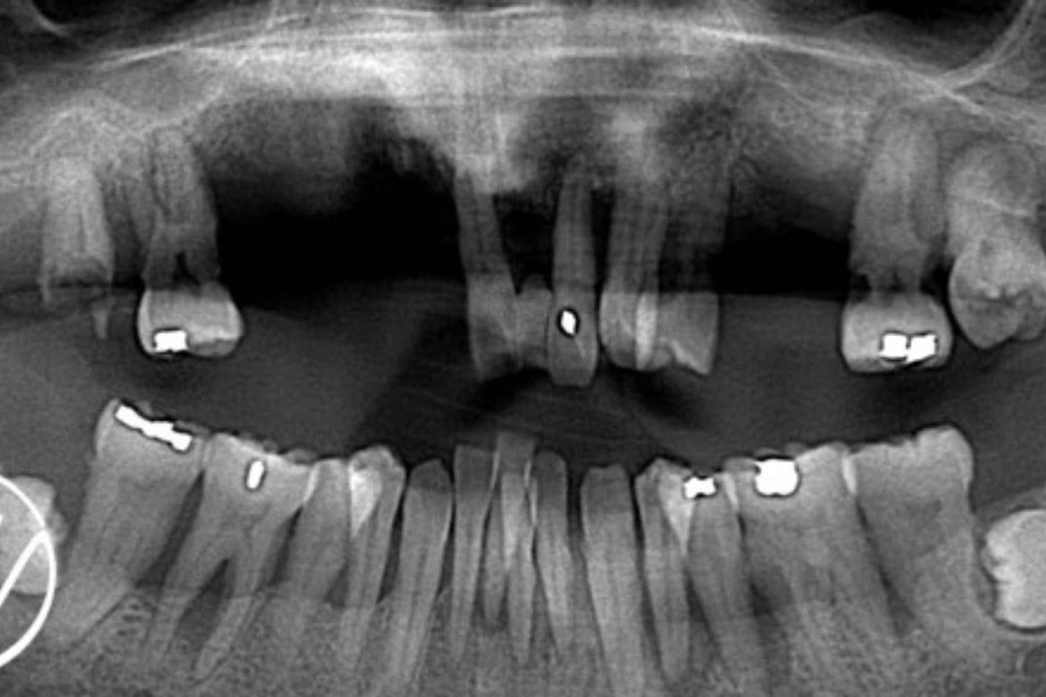 インプラント治療前(レントゲン)