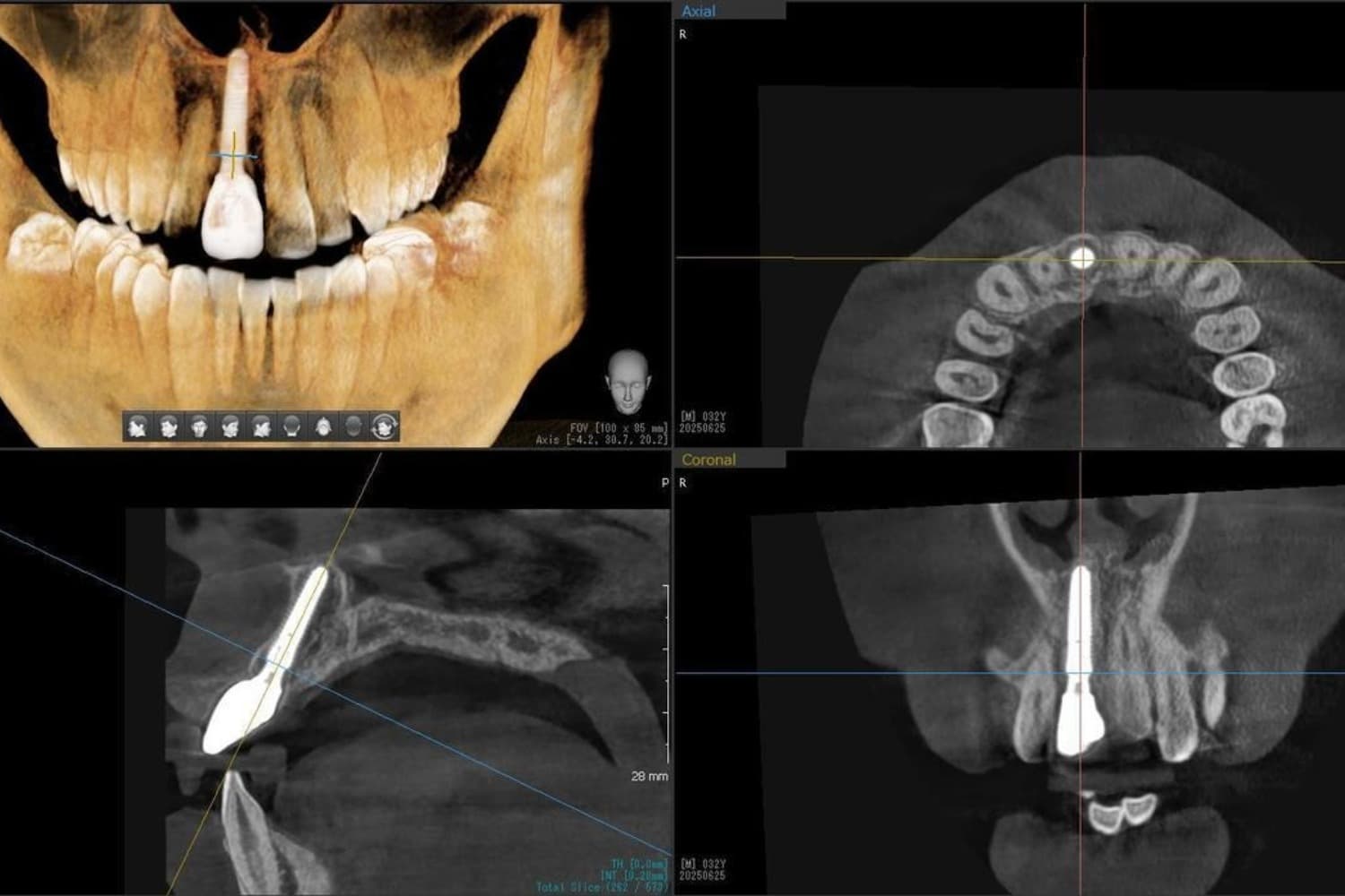 インプラント治療後(レントゲン写真)