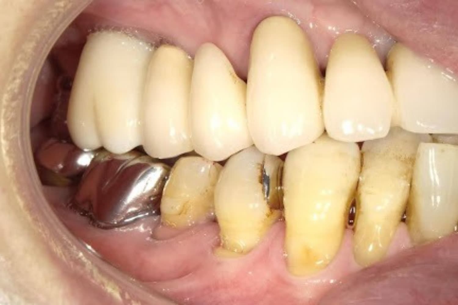 インプラント治療後