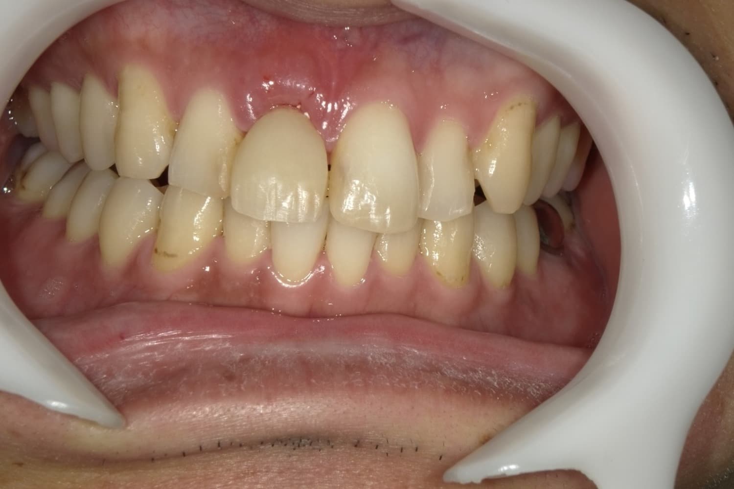 インプラント治療後