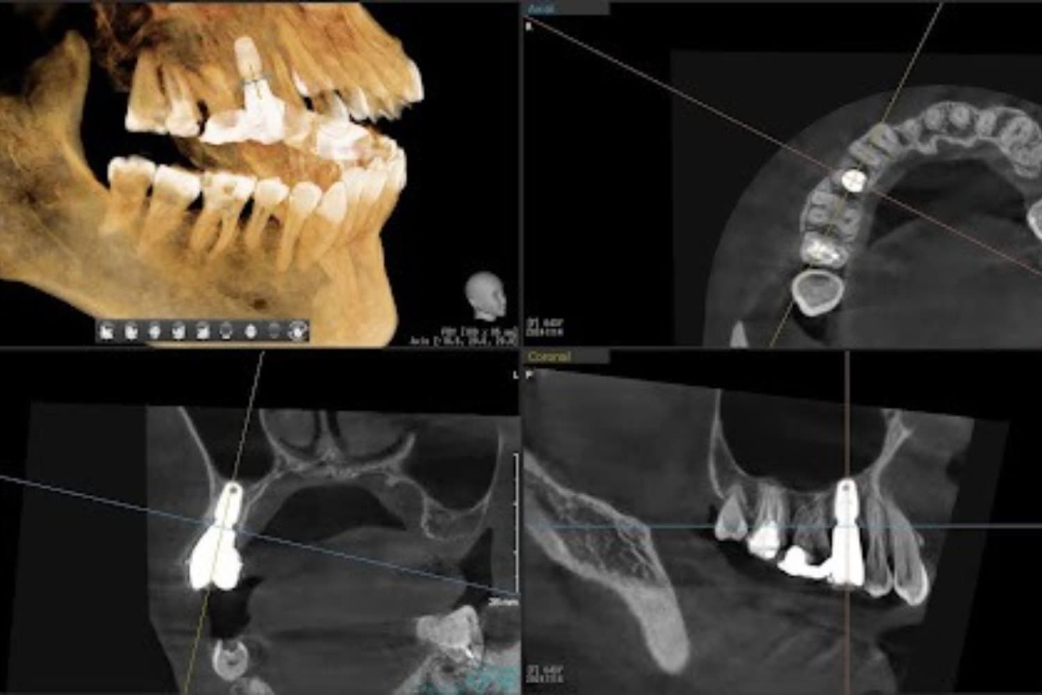 インプラント治療後(レントゲン写真)