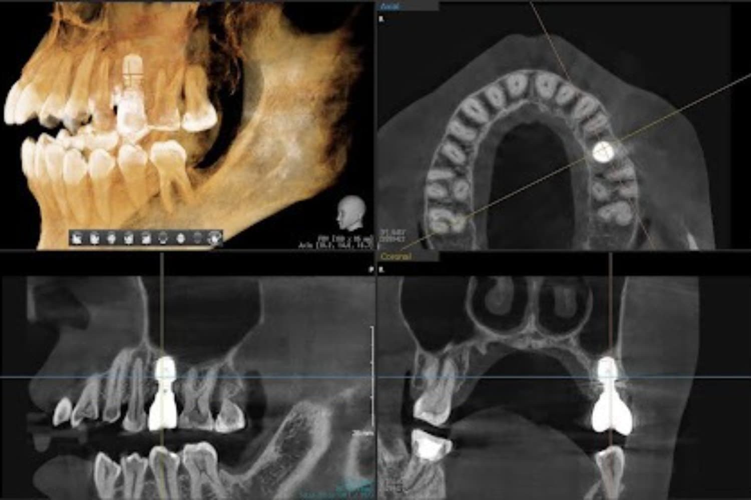 インプラント治療後(レントゲン写真)