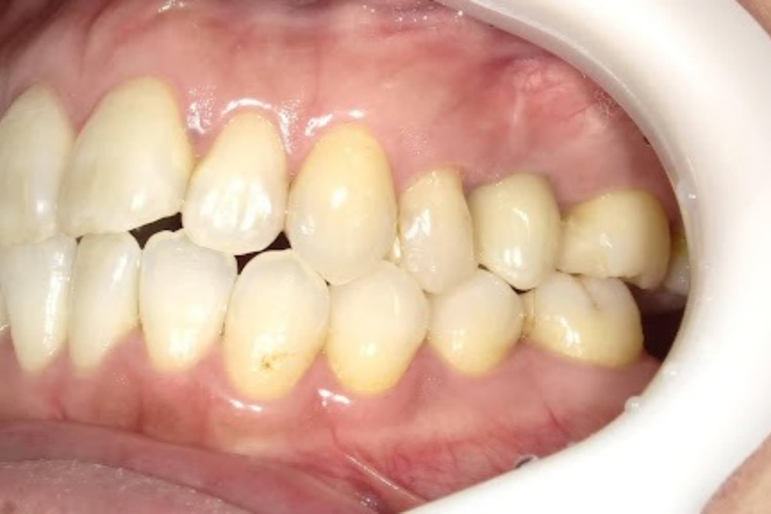 インプラント治療後