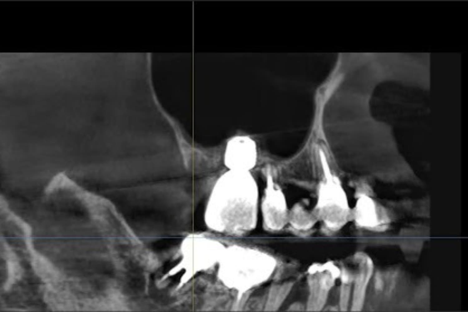 インプラント治療後(レントゲン写真)