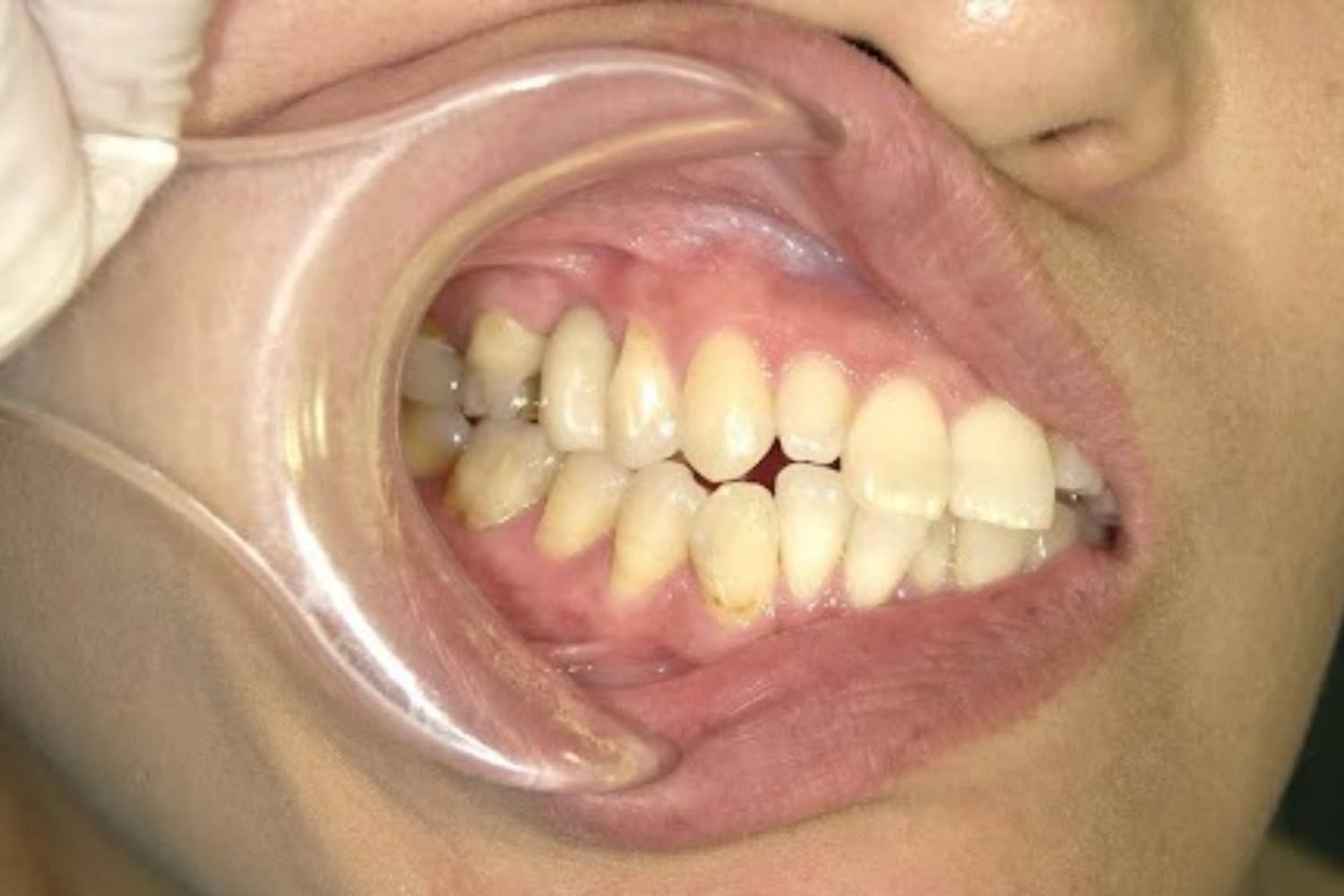 インプラント治療後