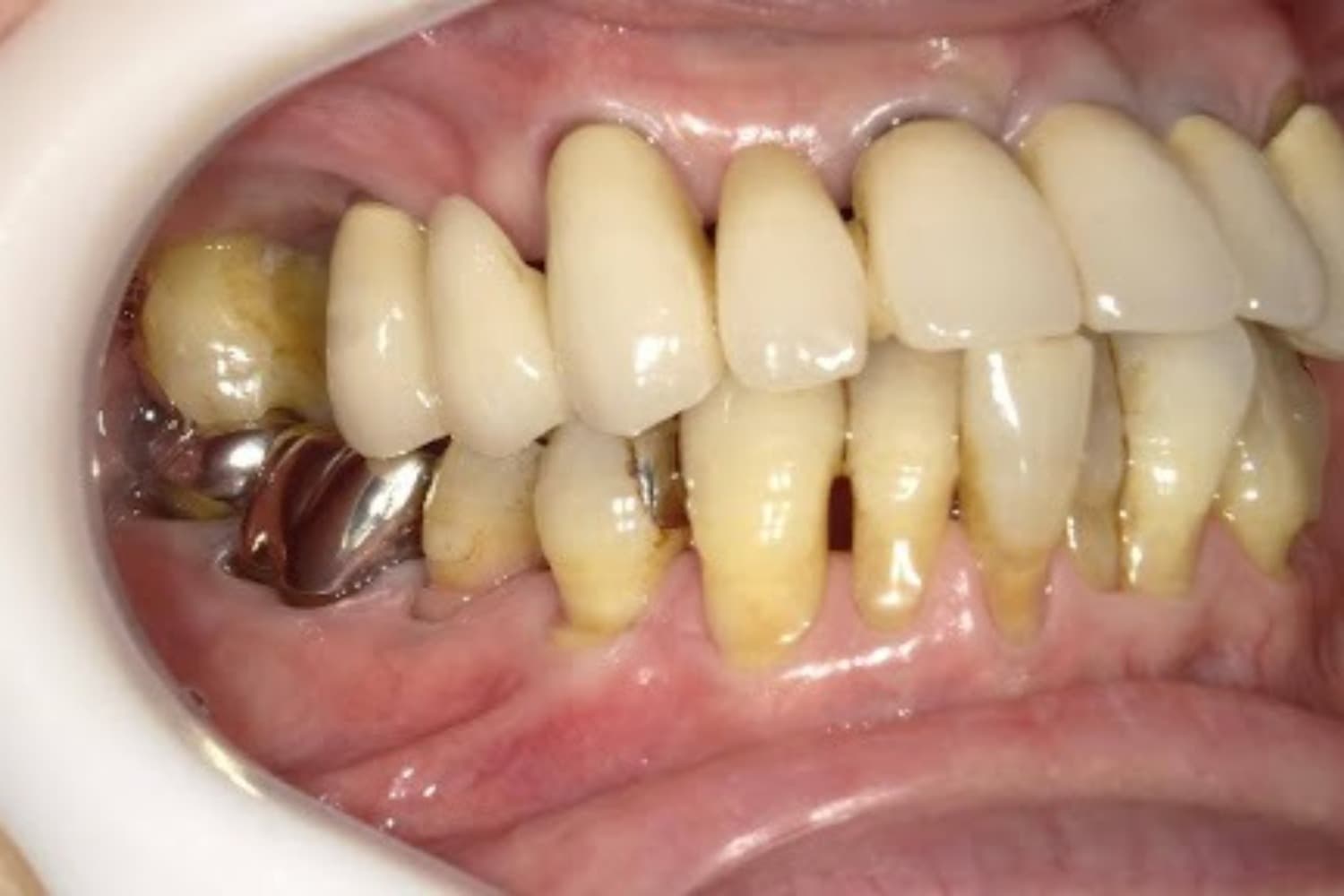 インプラント治療前