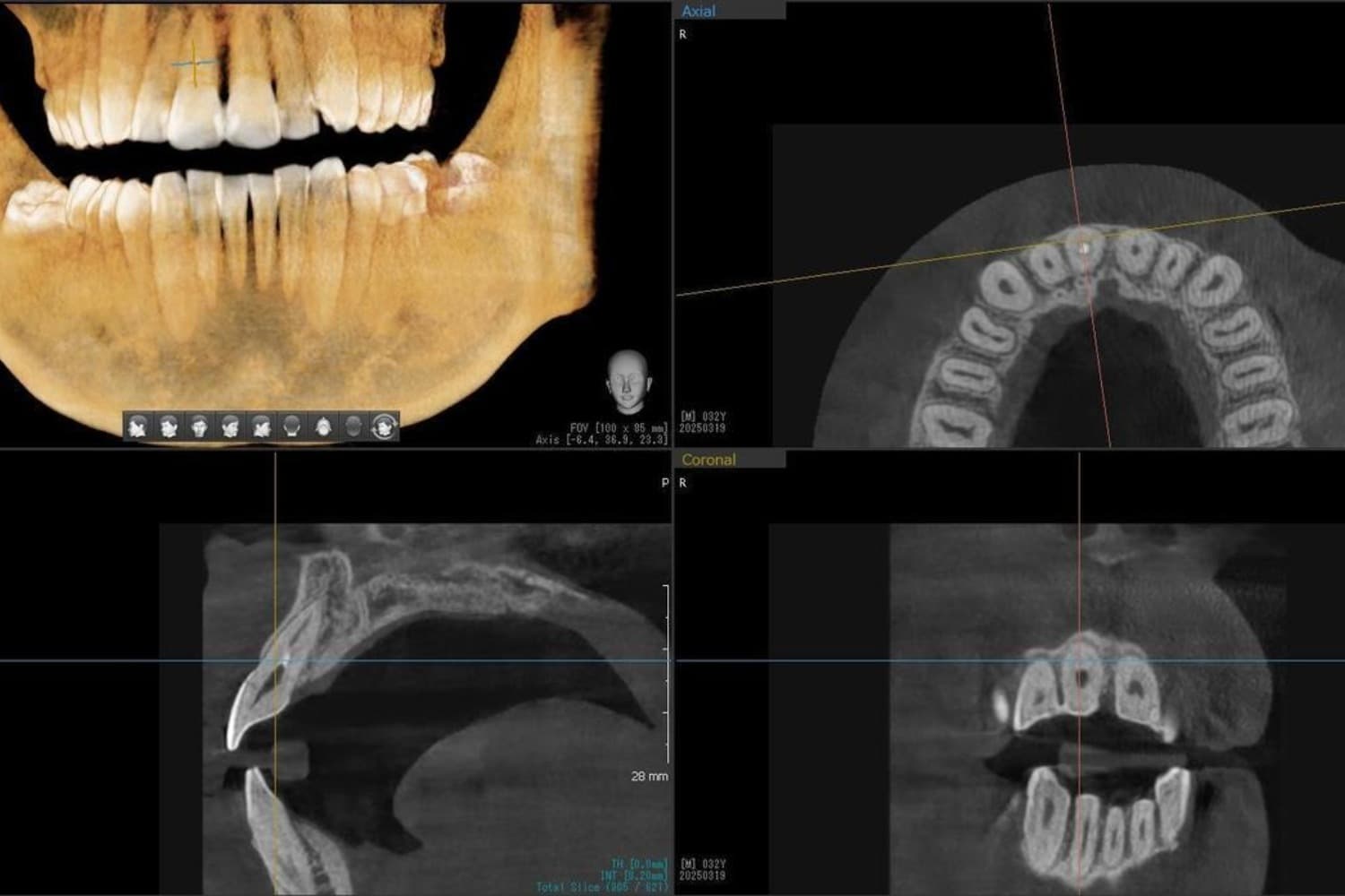 インプラント治療前(レントゲン写真)