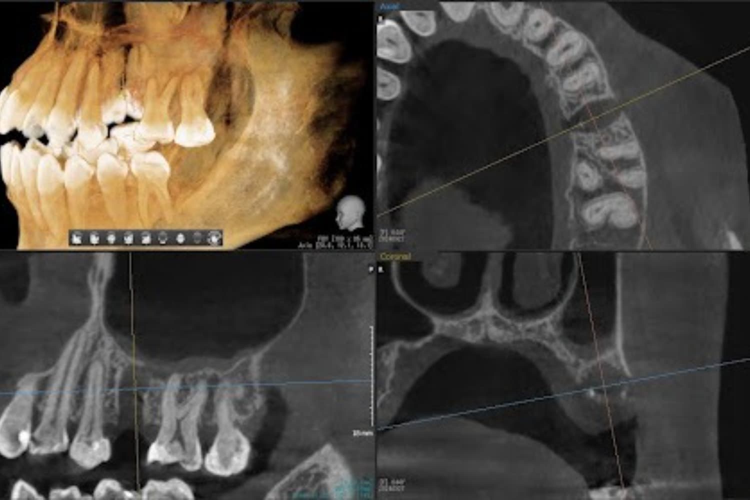 インプラント治療前(レントゲン写真)