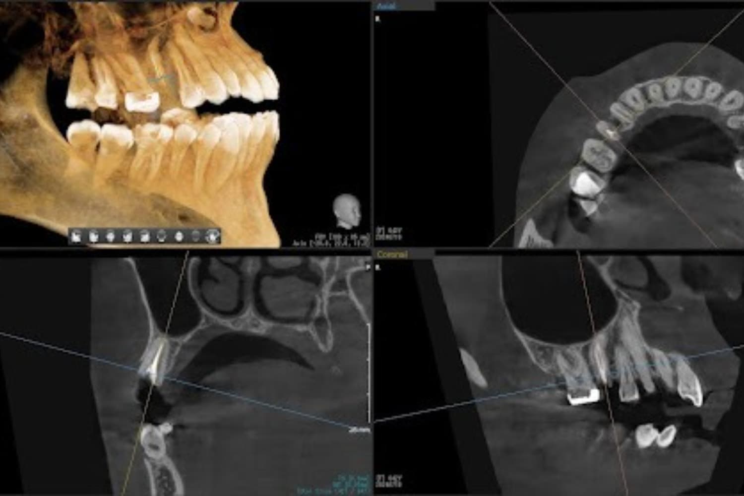 インプラント治療前(レントゲン写真)