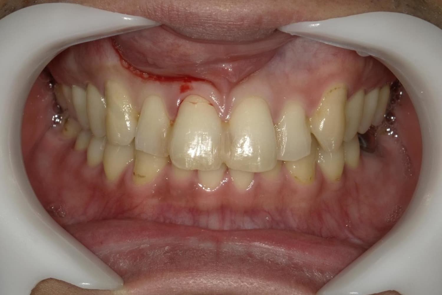 インプラント治療前