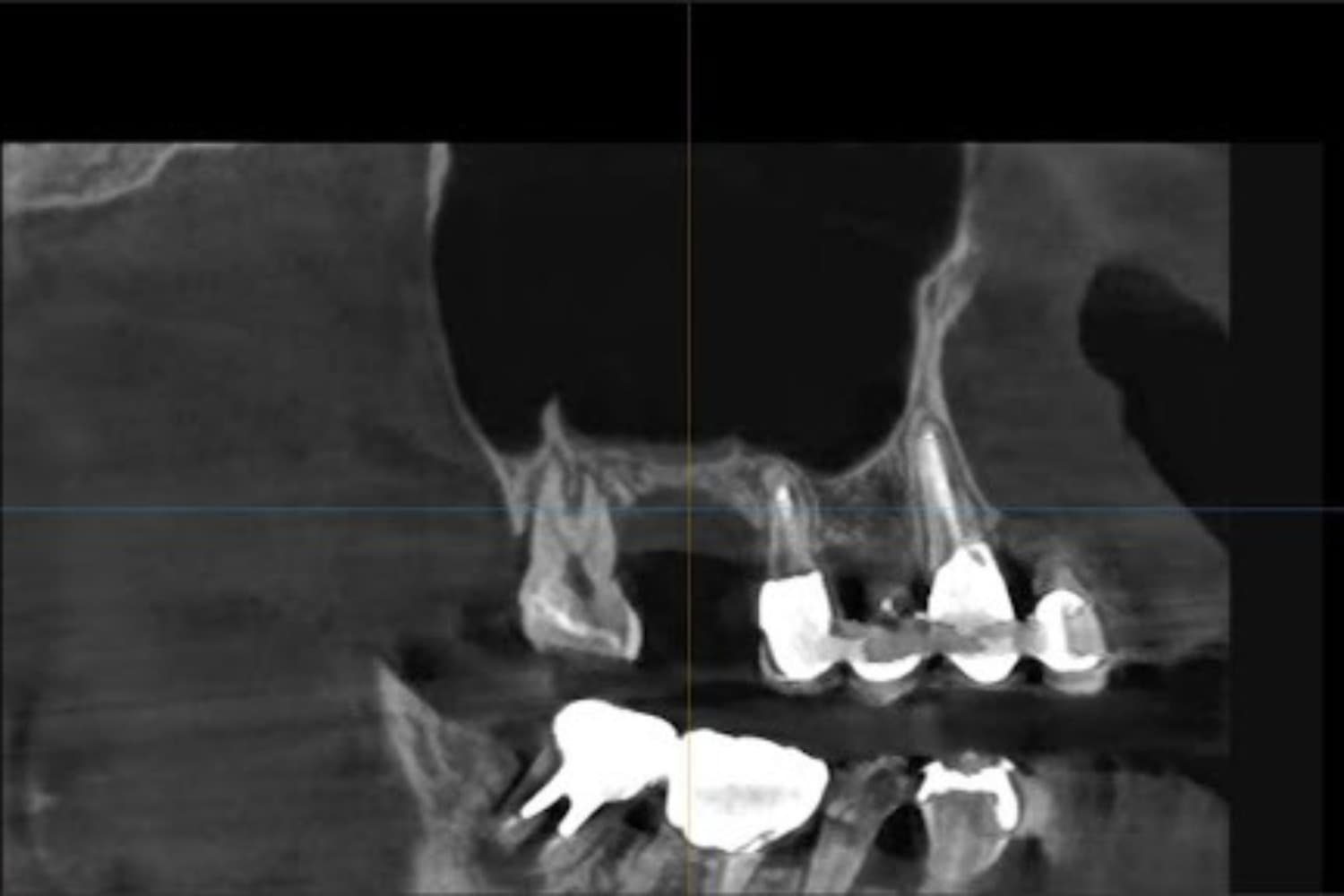 インプラント治療前(レントゲン写真)