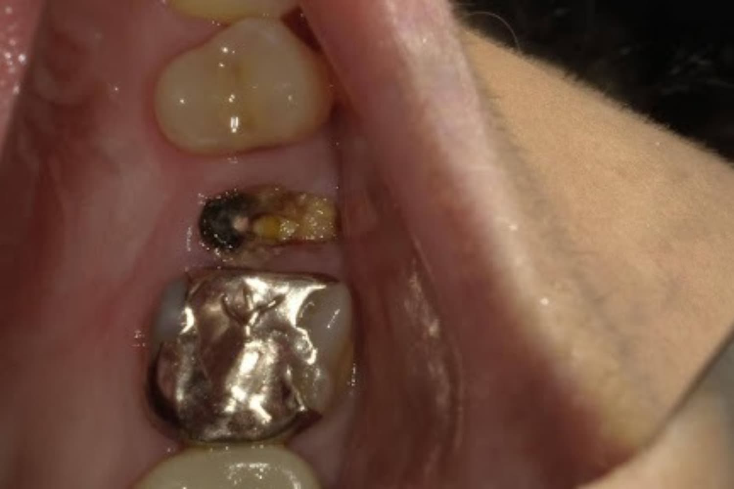 インプラント治療前