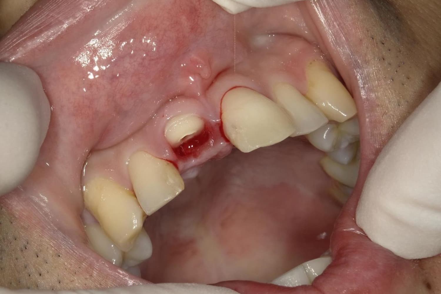 インプラント治療前