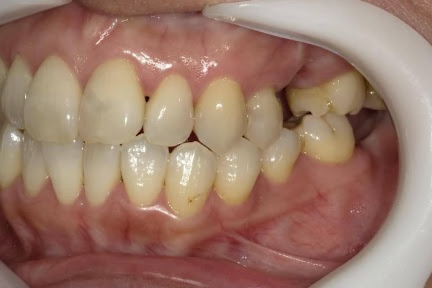 インプラント治療前