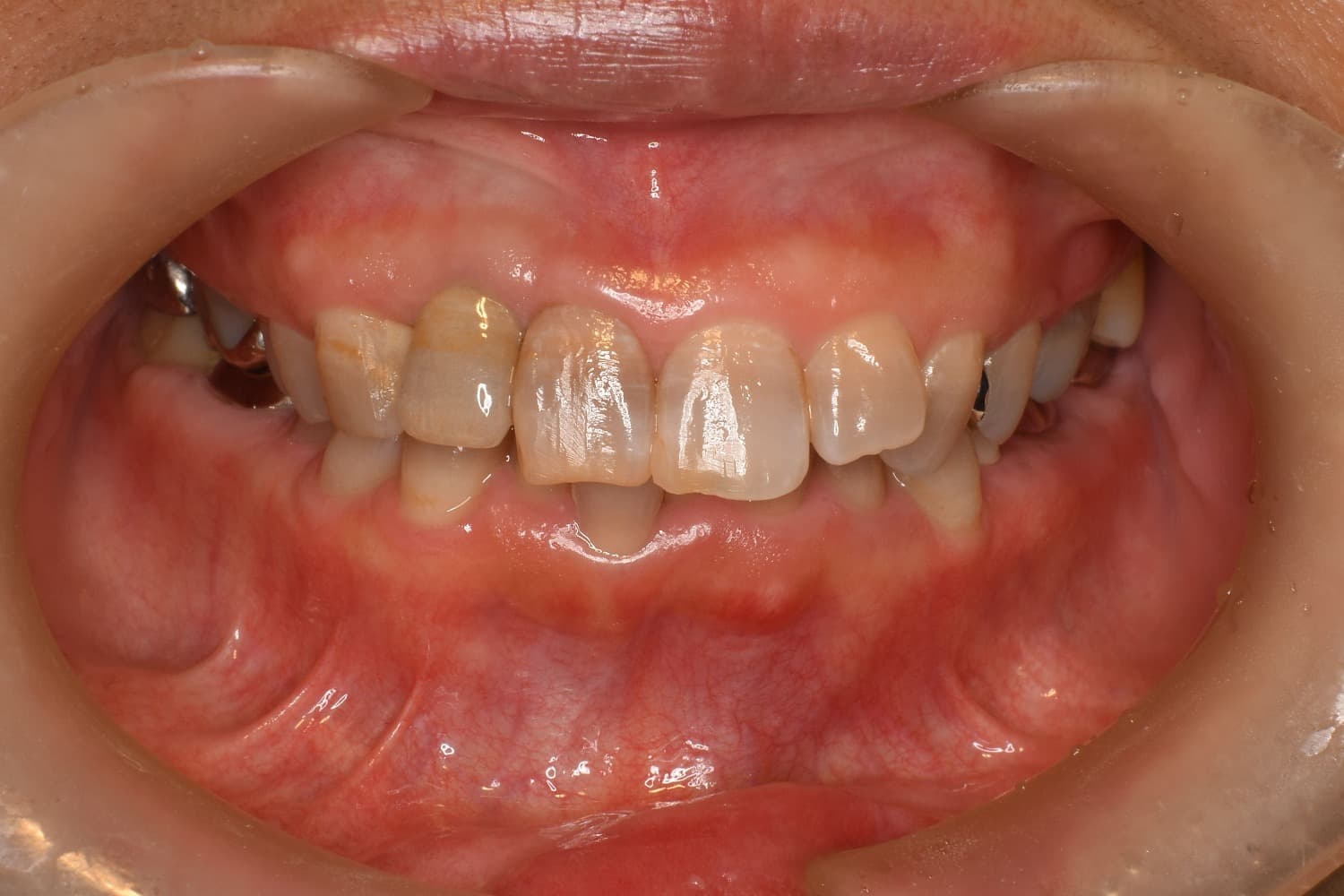 インプラント治療後:右上2番目の歯にインプラント治療をおこなう